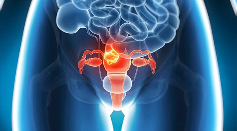 Cáncer ginecológico