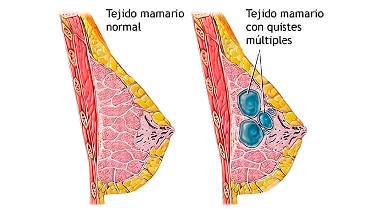 Imagen de Tumores de mama