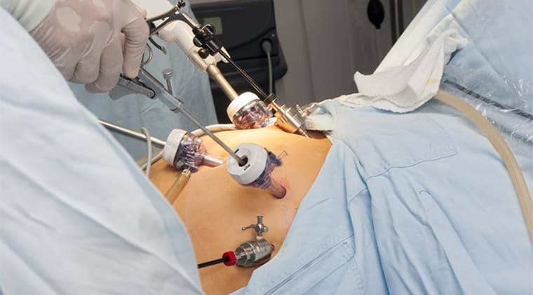 Cirugía laparoscópica