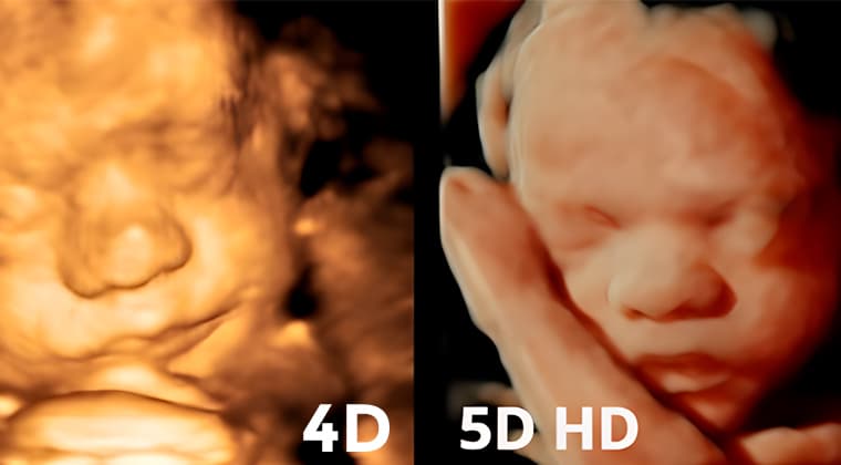 Ultrasonido 4D 5D
